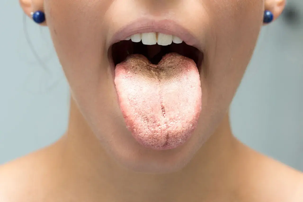 Lingua con patina biancastra e filamenti bianchi in bocca, segno di possibile infezione fungina.