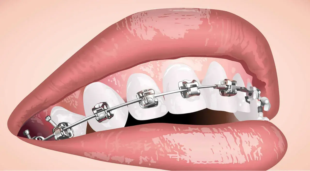 Denti con apparecchio metallico, parte di un percorso di cure ortodontiche per un sorriso perfetto.