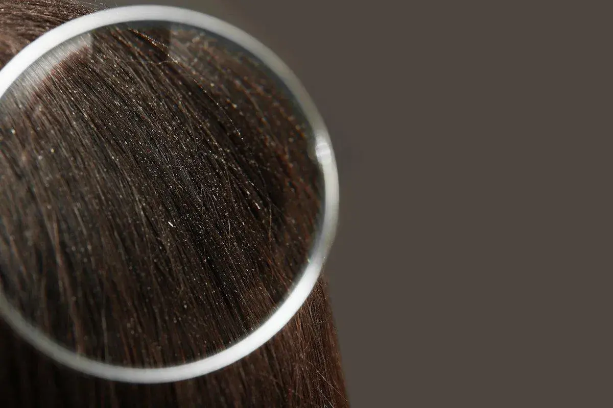 Capelli scuri con forfora visibile sotto lente d'ingrandimento. Scopri i migliori rimedi naturali per la forfora.