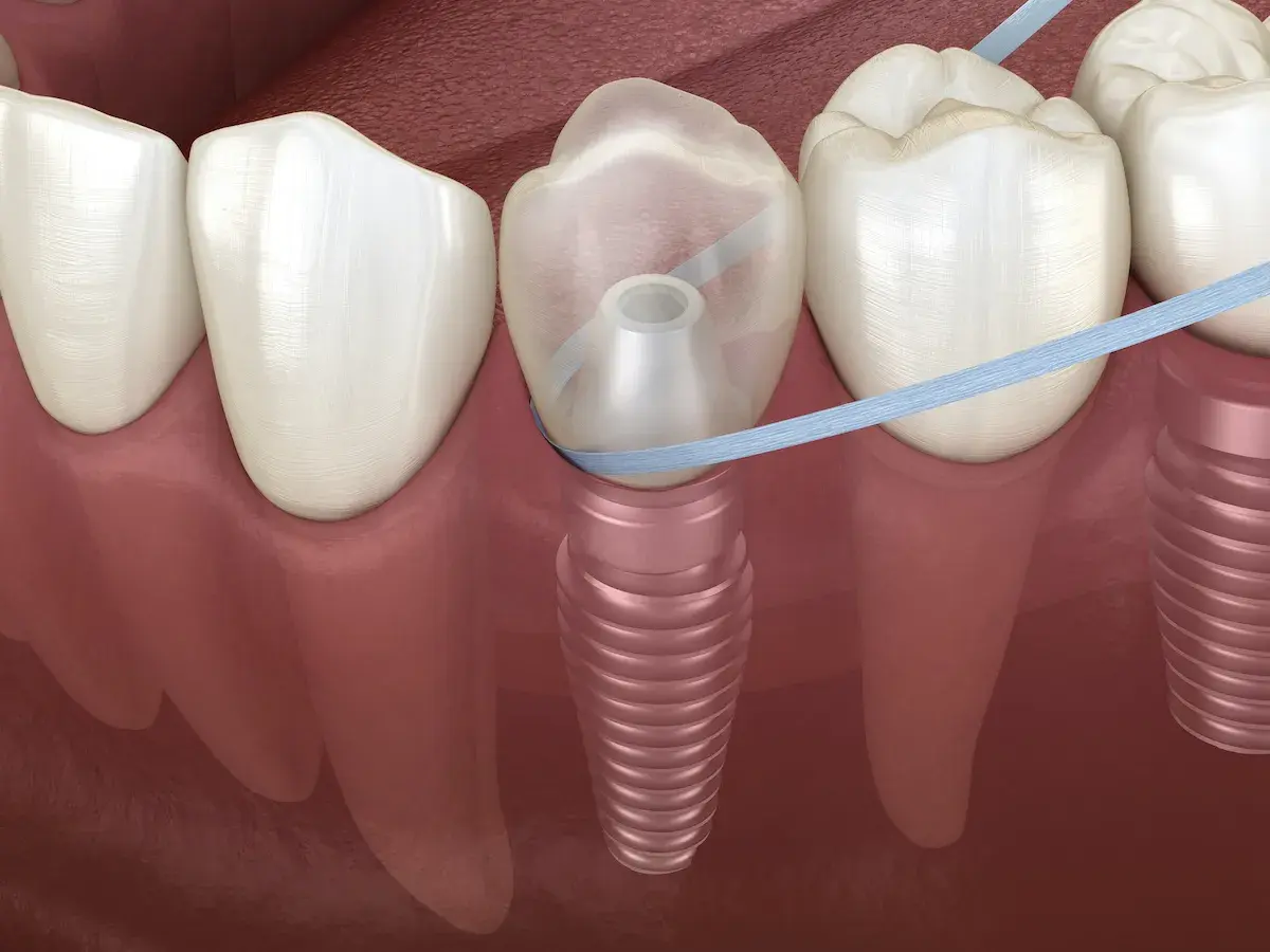 Filo interdentale che pulisce attorno a un impianto dentale. È importante prendersi cura dell'igiene orale, anche se si possono lavare i denti prima di un intervento.