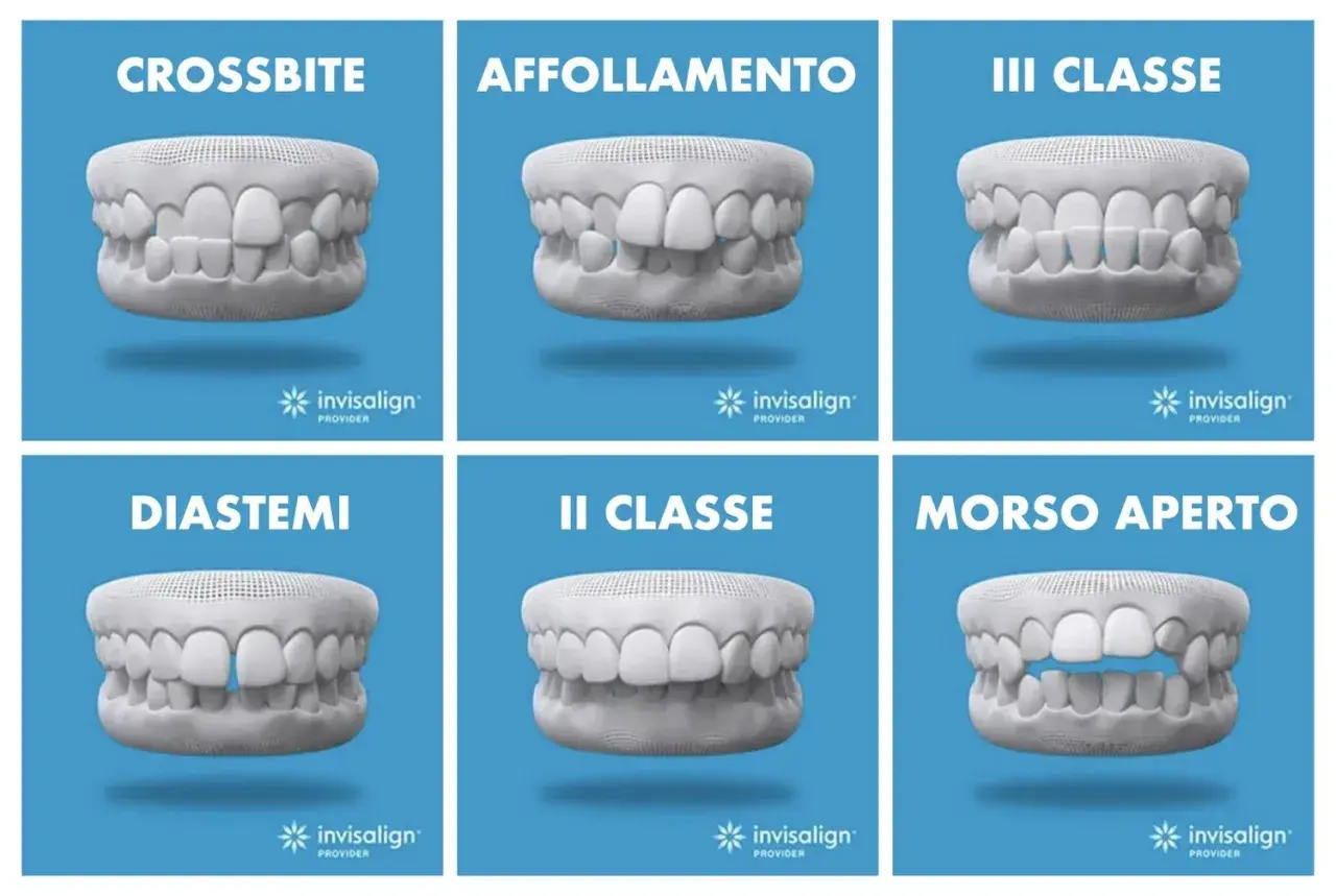 Sei casi di malocclusione dentale: crossbite, affollamento, III classe, diastemi, II classe, morso aperto. Soluzioni con mascherine invisalign.