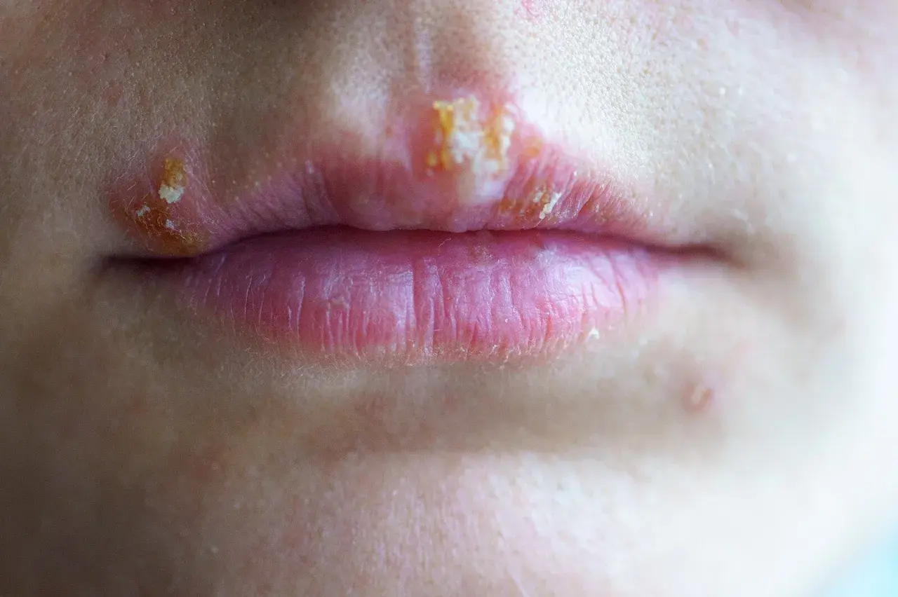 Labios con ampollas y costras, indicativo de herpes labial contagio.
