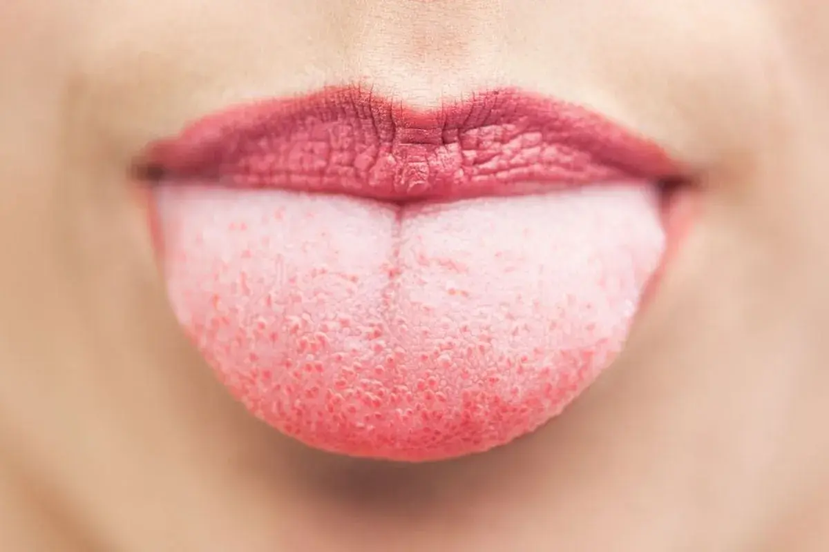Lingua rosa con puntini rossi, forse un segno di lingua streptococco. Labbra con rossetto scuro.