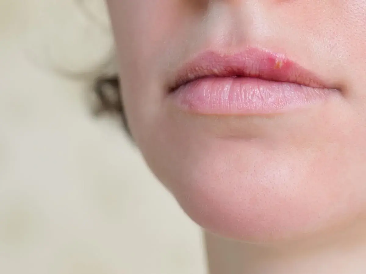 Primo piano delle labbra con una vescicola di herpes che indica perche esce herpes.