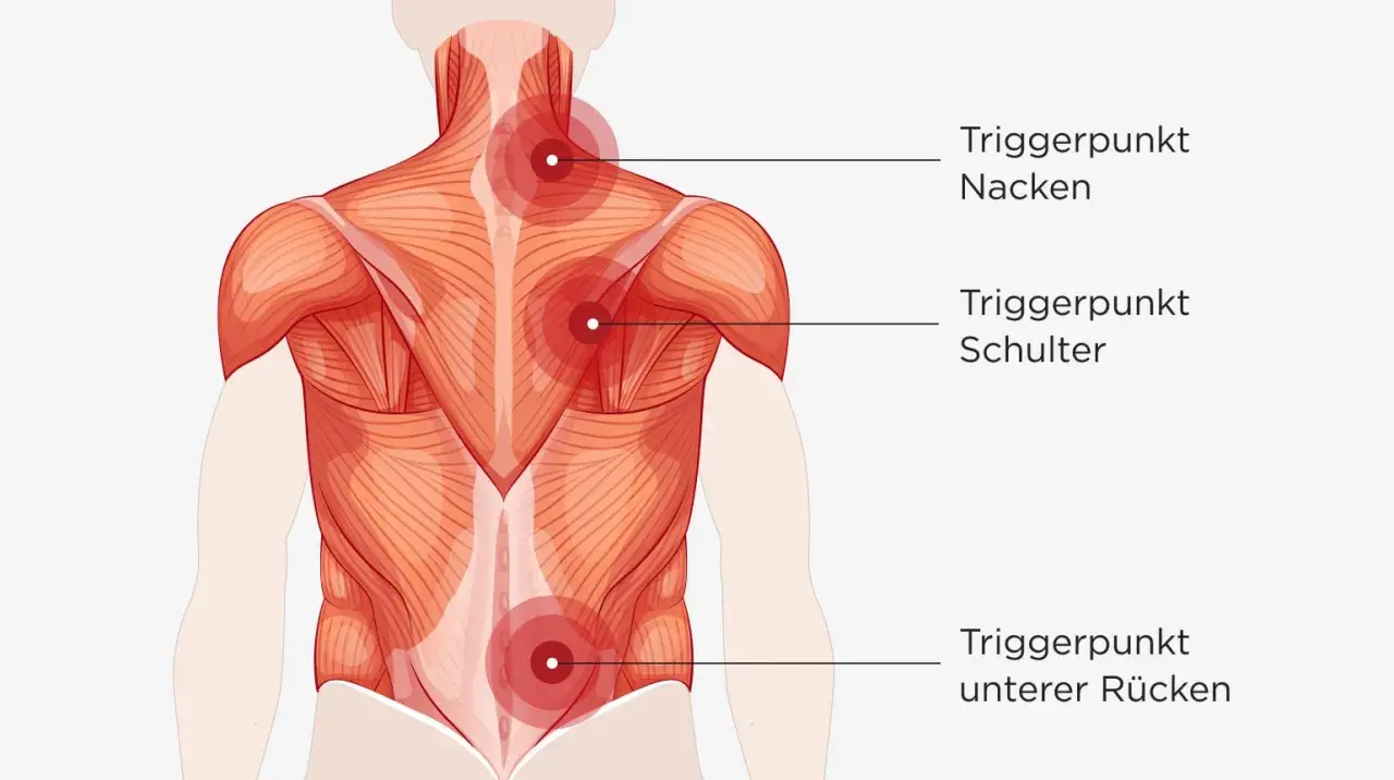 Muskelansicht des Rückens mit markierten Triggerpunkten im Nacken, an der Schulter und im unteren Rücken, die auf hws myogelose hinweisen.
