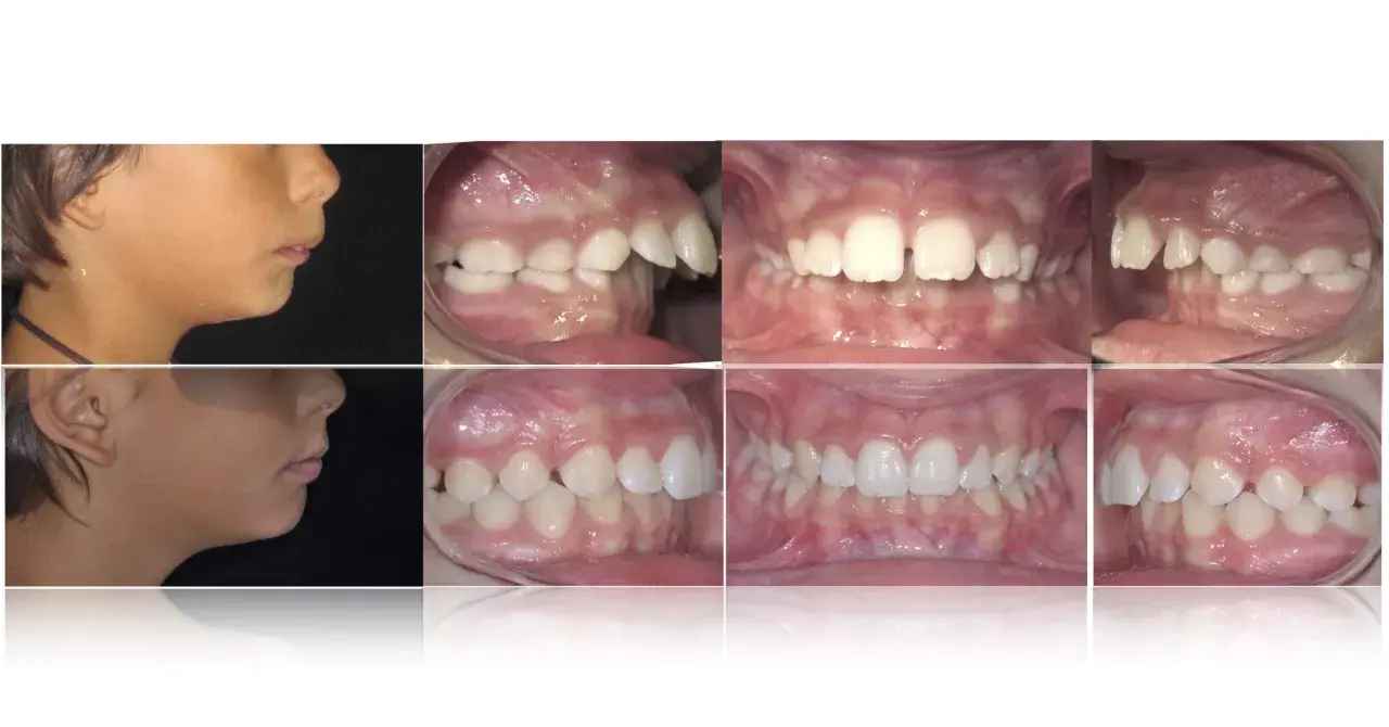 Prima e dopo: profilo di un bambino con apparecchio denti sporgenti e immagini ravvicinate dei suoi denti prima e dopo il trattamento ortodontico.