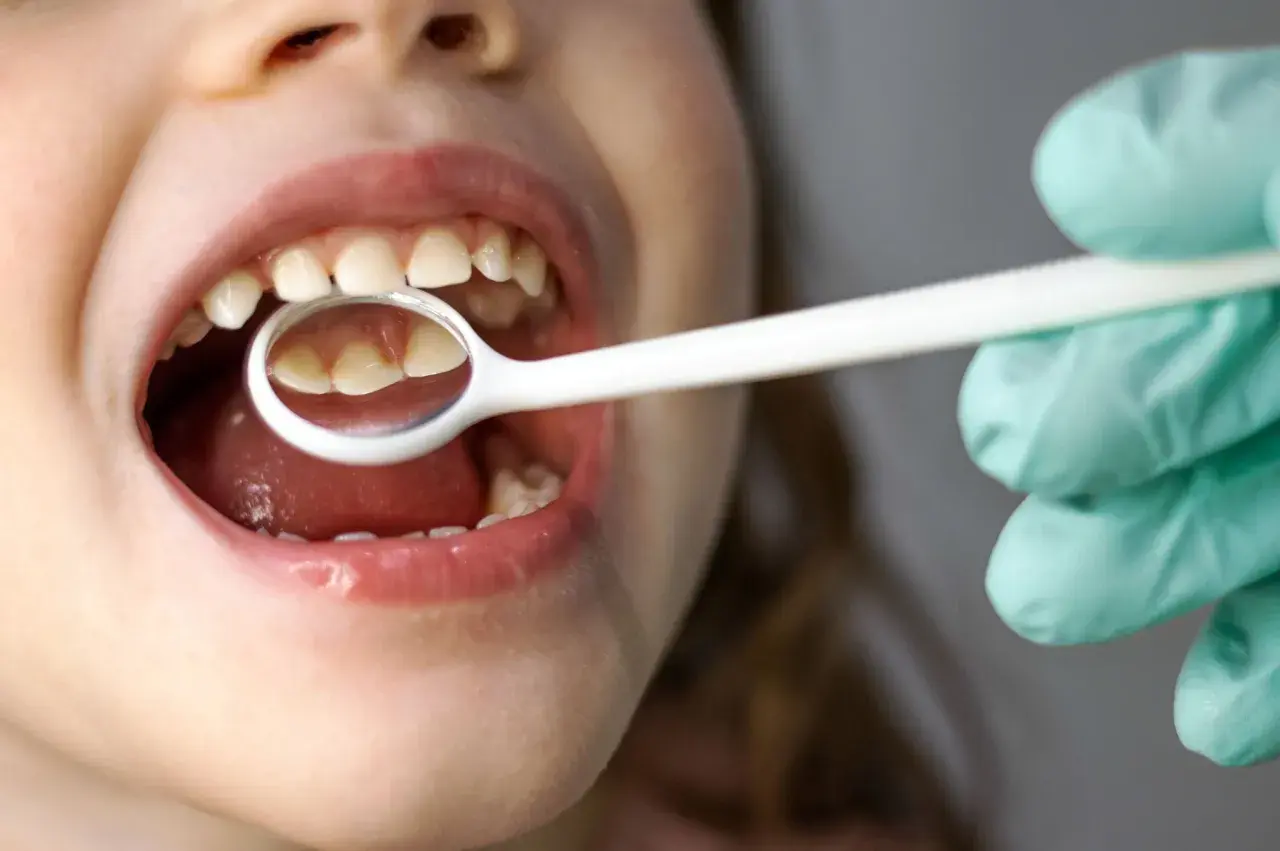 Bocca di un neonato con ciuccio, mentre un dentista esamina i suoi dentini con uno specchietto.