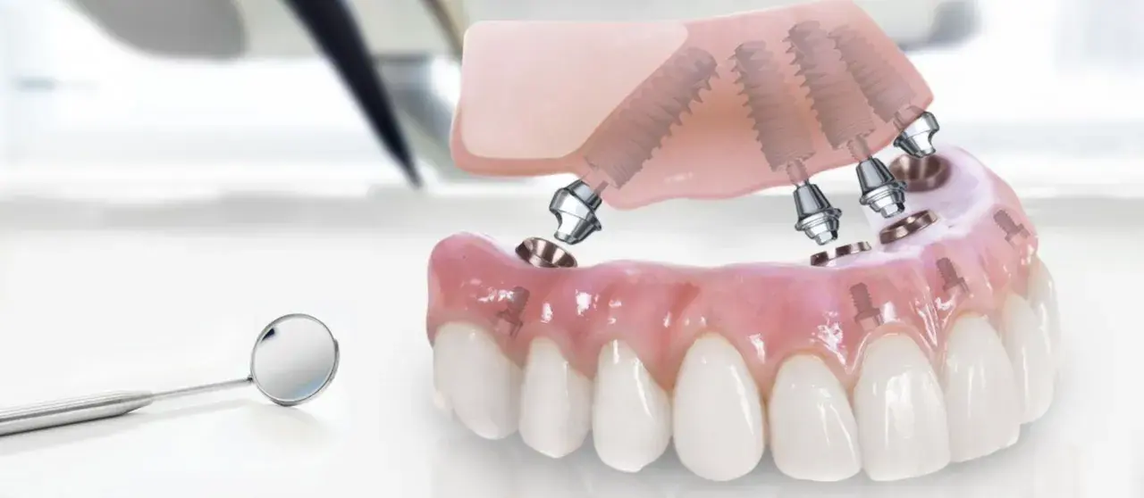 Model szczęki z implantami, gotowy do montażu. Rozważ implanty w Turcji dla pięknego uśmiechu.