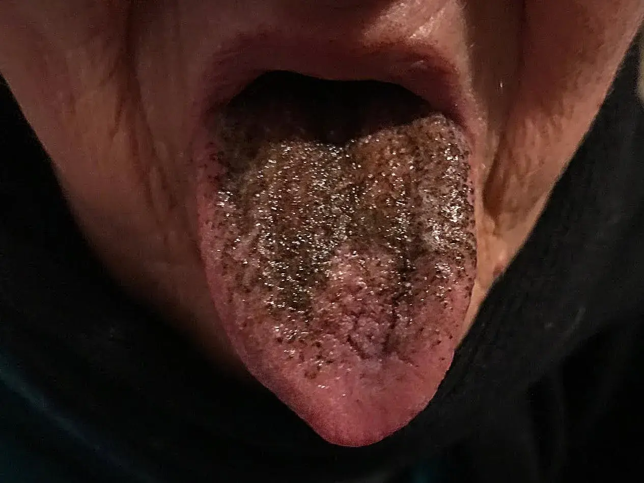 Lingua nera con papille ispessite e macchie scure, come se fosse coperta di terra.
