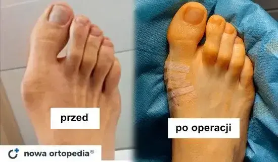 Haluksy: operacja prywatnie czy na NFZ? Pełne koszty i porady