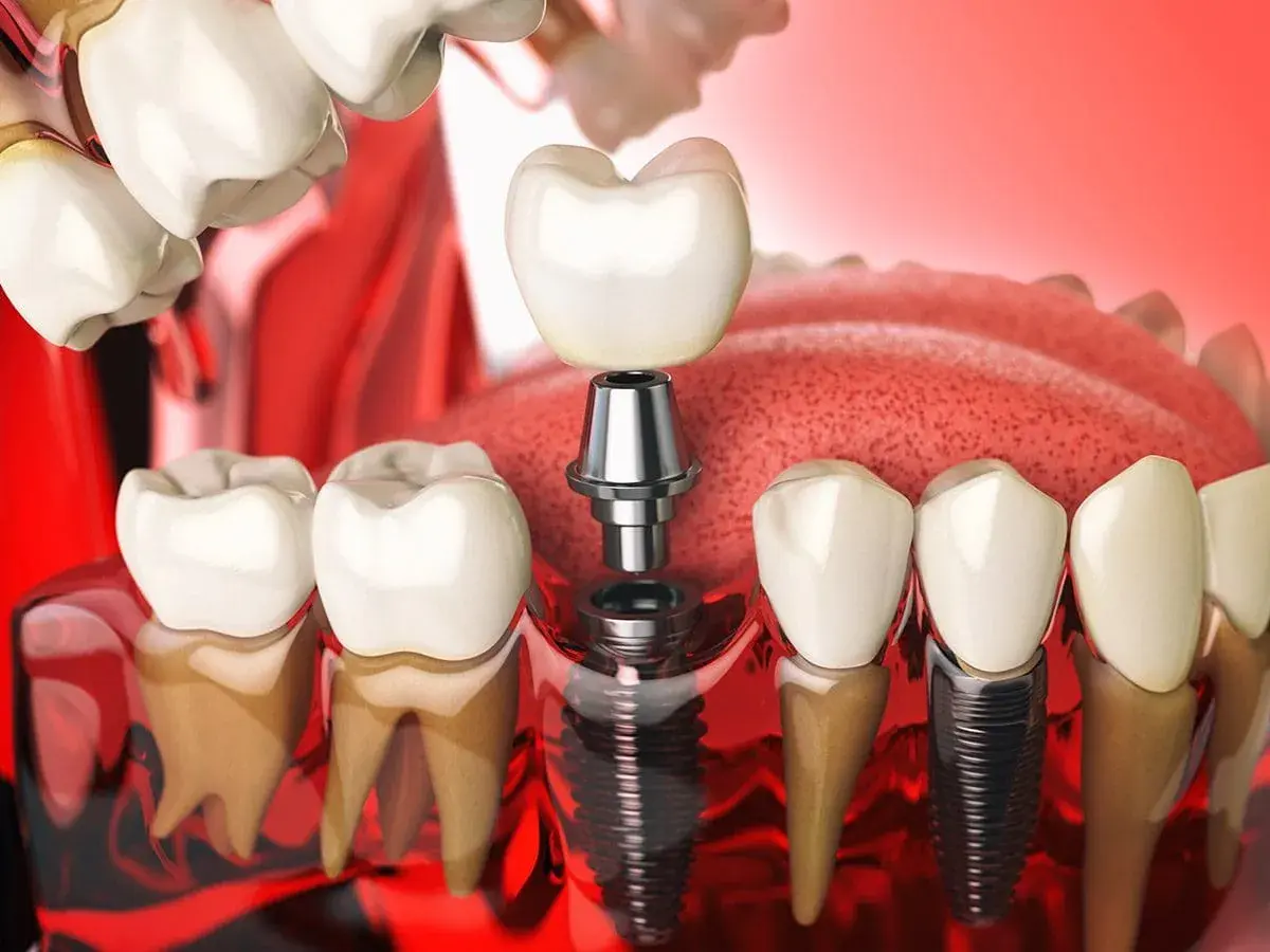 Illustrazione di un impianto perno dente, con la vite inserita nell'osso e la corona in attesa di essere posizionata.