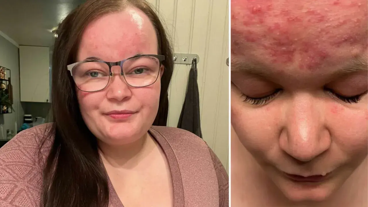 Kvinna med glasögon visar upp sin hud med rodnad och utslag, troligen mild rosacea.