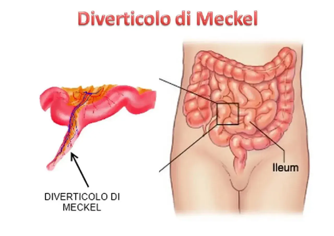 Illustrazione anatomica che mostra un diverticolo di Meckel, una piccola sacca nell'intestino tenue.