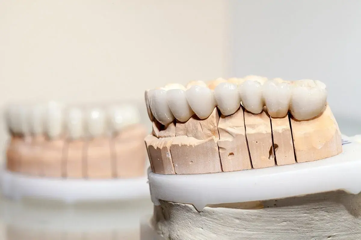 Modelli di denti in porcellana su un supporto in gesso, pronti per essere applicati.