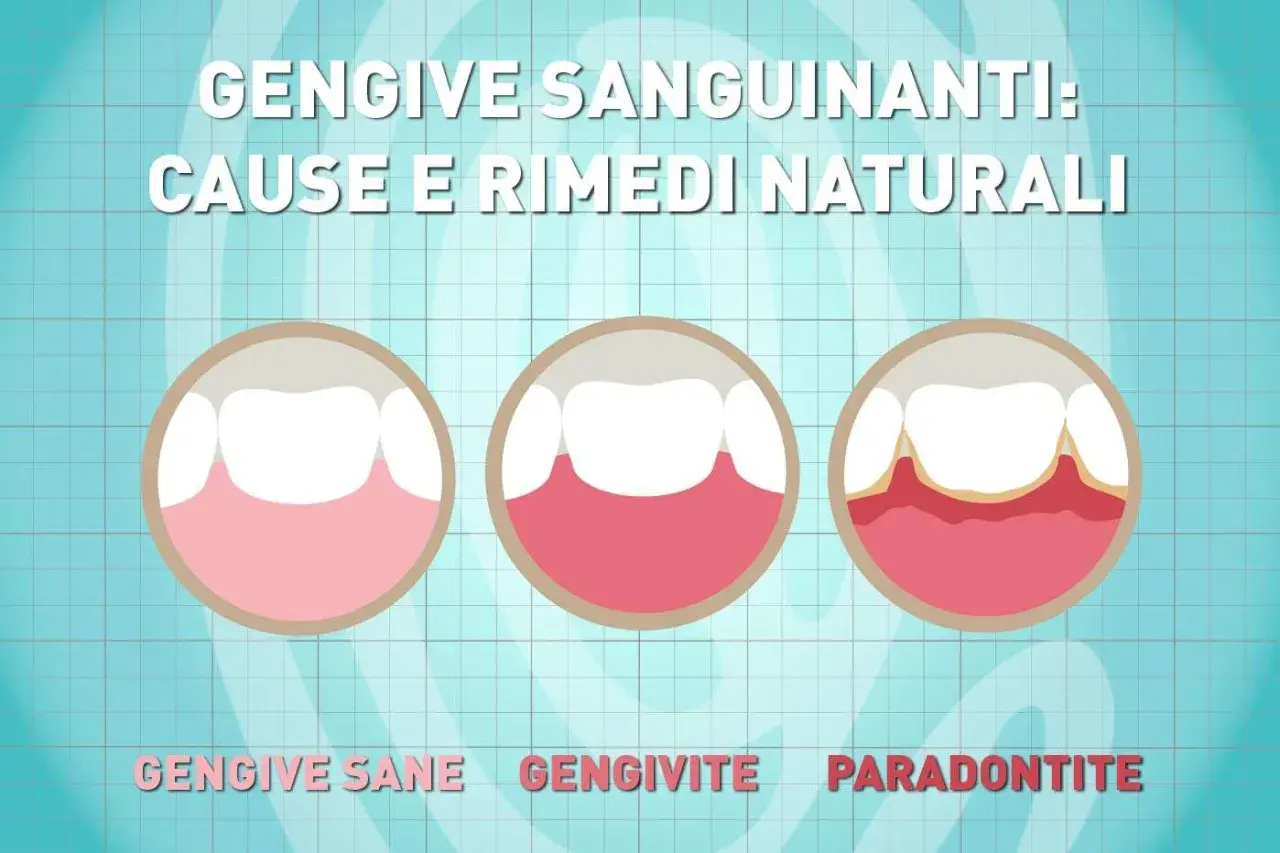 Illustrazione mostra gengive sane, gengivite e parodontite, con la progressione che porta a gengive sanguinanti.