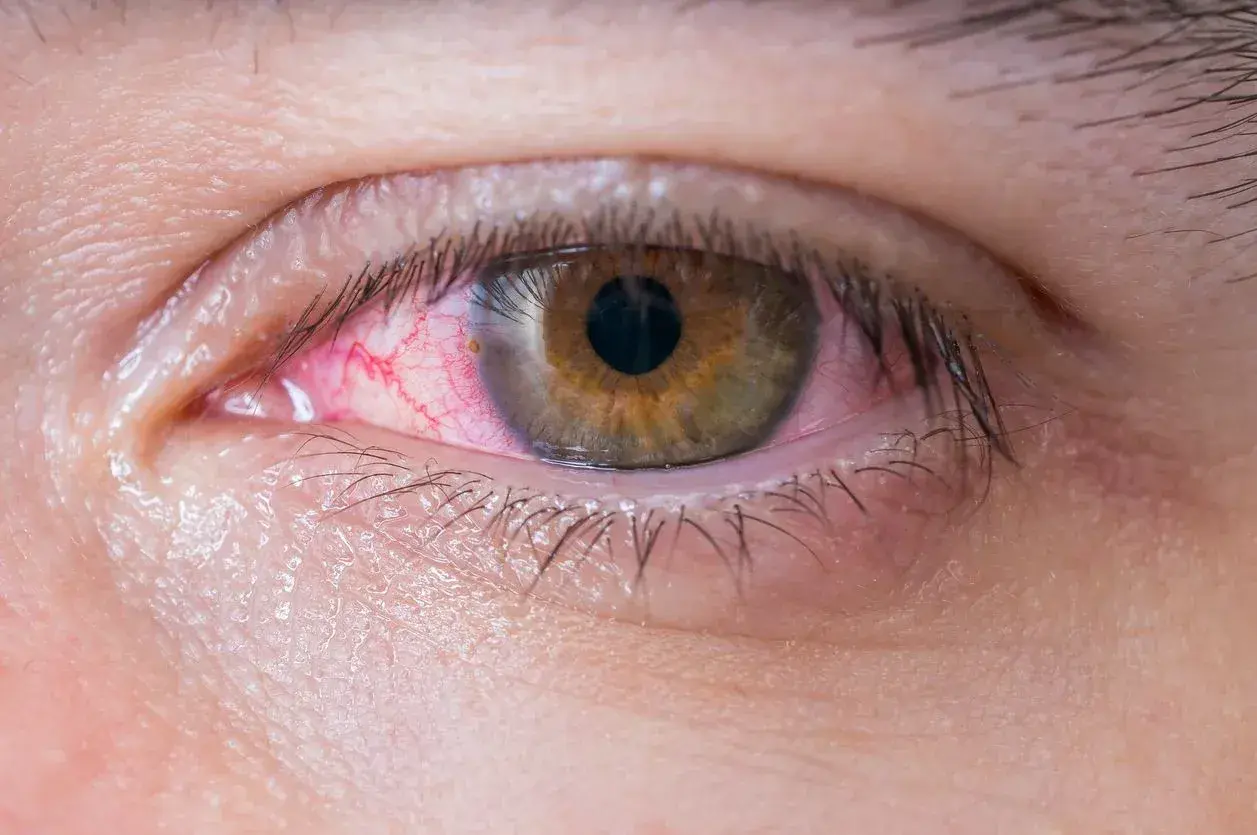 Ojo rojo e irritado, con vasos sanguíneos visibles. Ayuda a entender la diferencia entre conjuntivitis y mocos en los ojos.