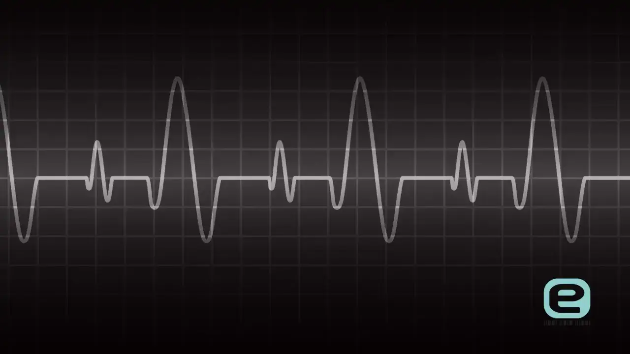 Nieregularny zapis EKG na czarnym tle. Pokazuje, jakie są objawy arytmii serca, gdy rytm jest zaburzony.