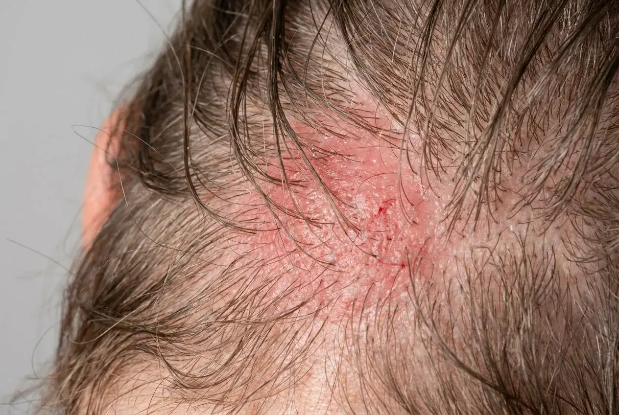 Rote, gereizte Kopfhaut mit kleinen Kratzern. Suche nach aufgekratzte Haut Hausmittel, um Linderung zu finden.