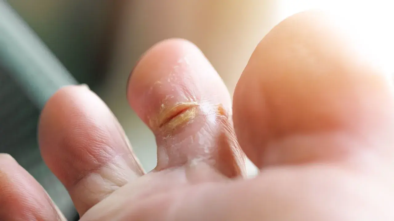 Pieds affectés par une mycose, peut-être contractée à la piscine. La peau entre les orteils est irritée et squameuse.