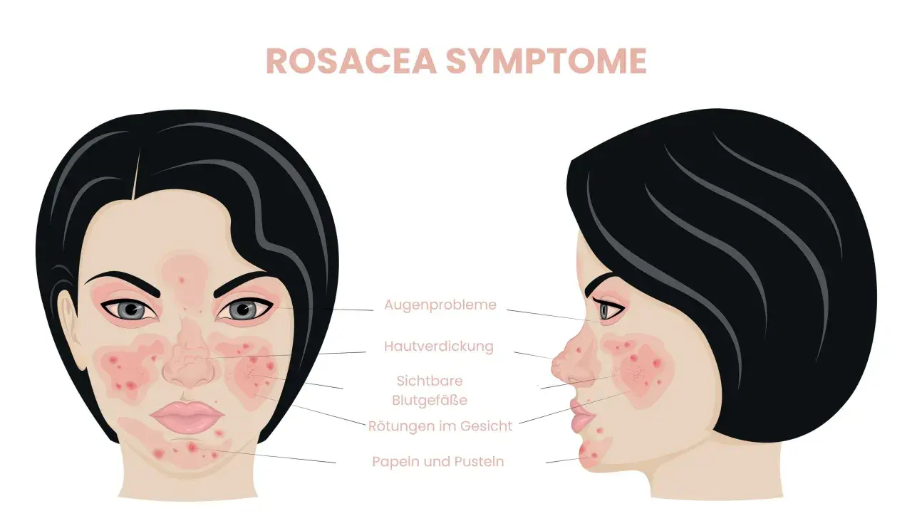 Rosacea-Symptome: Rötungen, sichtbare Gefäße, Papeln. Hausmittel können Linderung bringen.