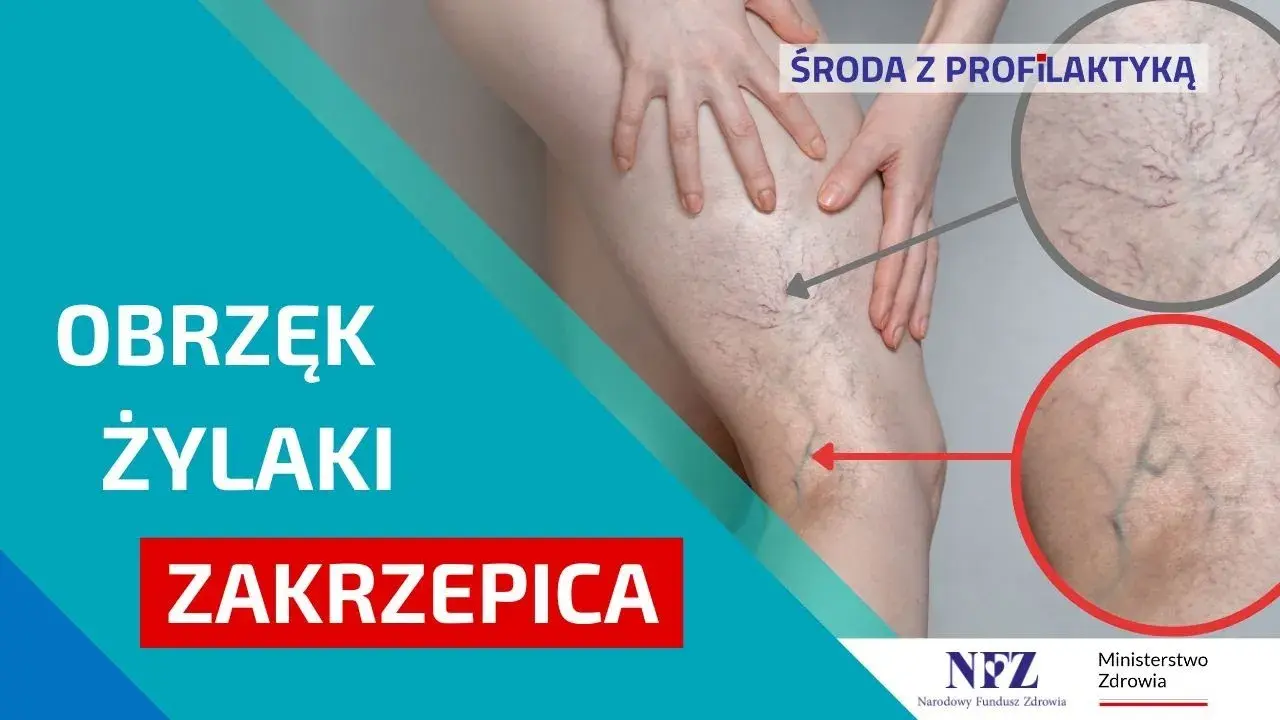 Jak zapobiec zakrzepicy? Skuteczna profilaktyka krok po kroku