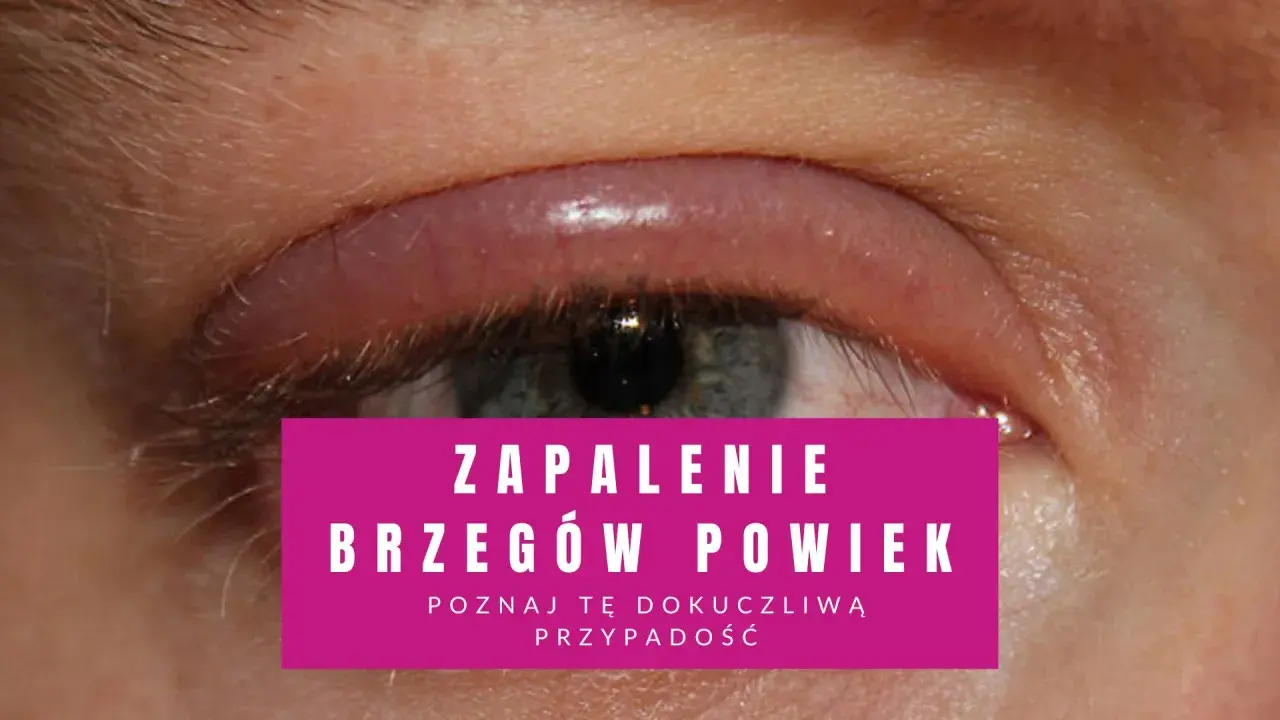 Oko z zaczerwienionym, opuchniętym brzegiem powieki, wskazujące na łojotokowe zapalenie powiek.