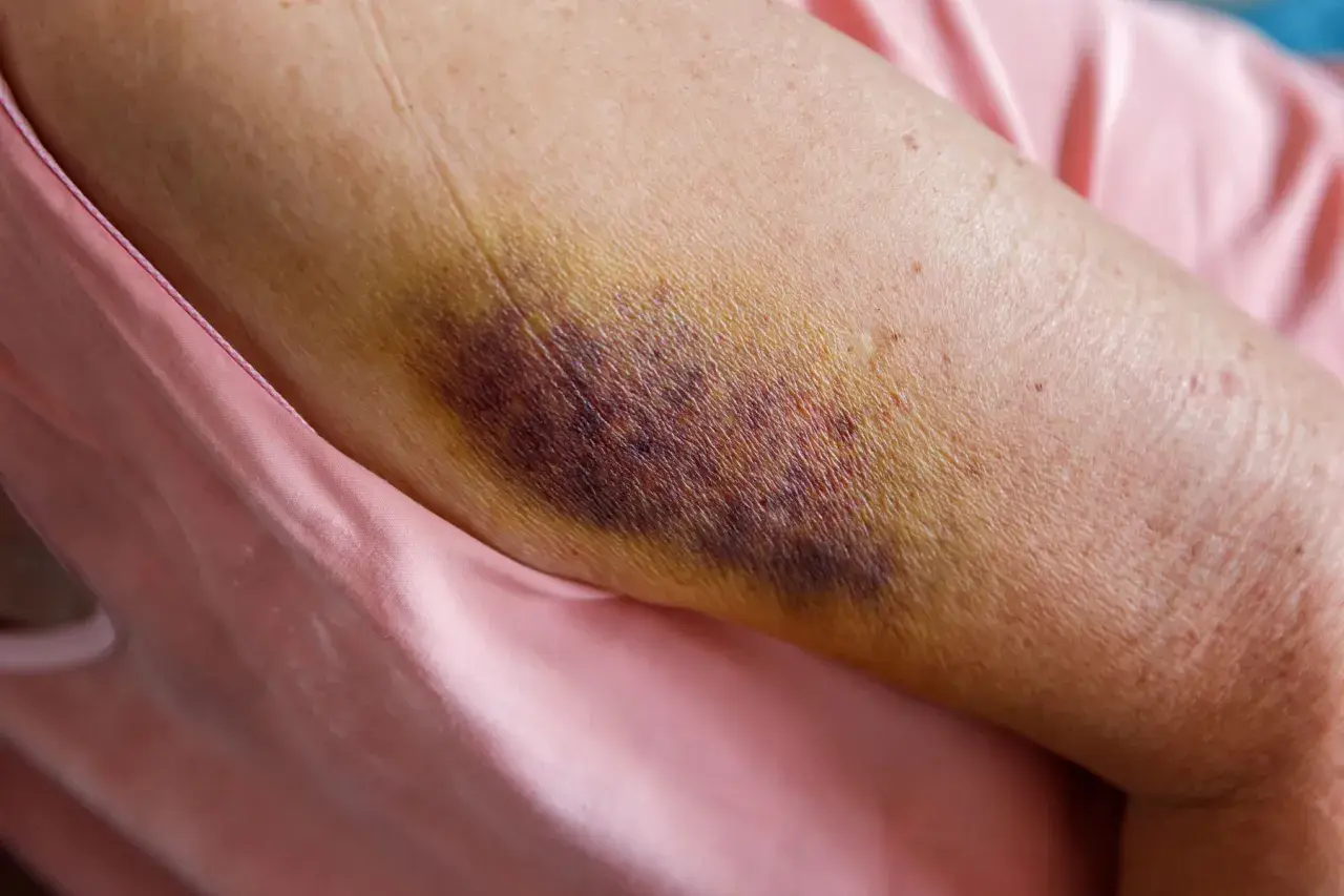 Gros hématome violacé sur un bras, signe d'une jambe en sang suite à un choc. La peau est meurtrie et jaunie par endroits.