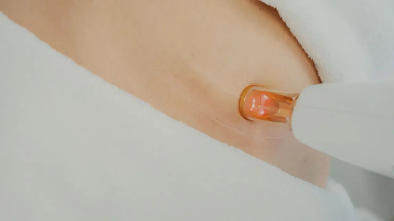 Närbild på hud med laserbehandling för bristningar. En vit apparat med orange spets närmar sig huden.