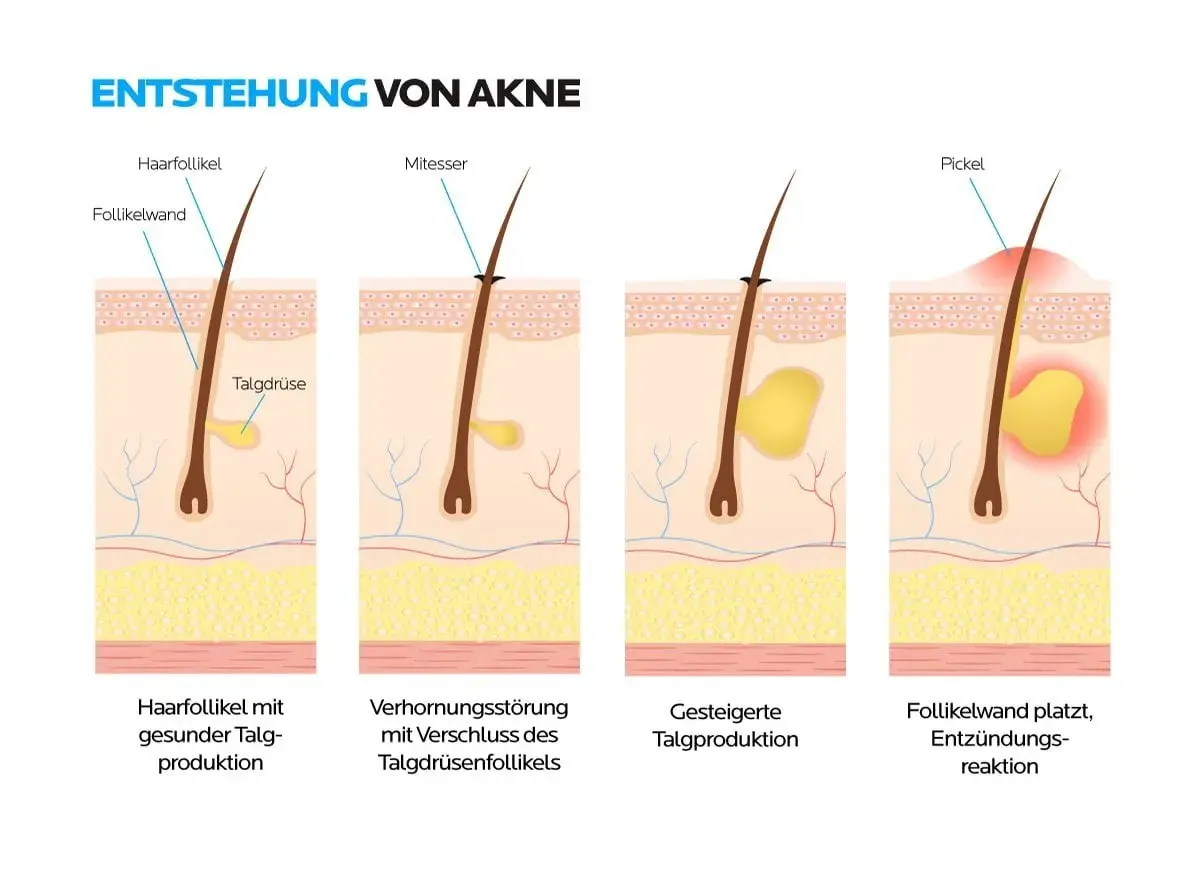 Illustration zeigt, wie entstehen Mitesser: Verhornungsstörung und erhöhte Talgproduktion führen zu verstopften Follikeln, die sich entzünden.