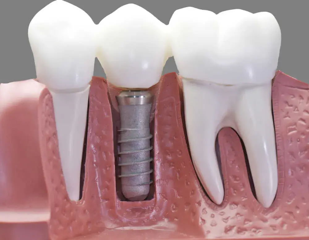 Czy po wszczepieniu implantu zęba można iść do pracy bez obaw?