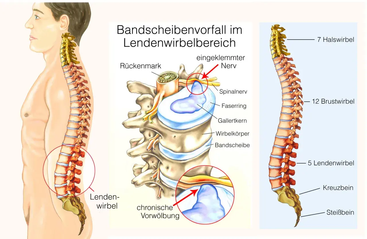 Illustration zeigt Bandscheibenvorfall im Lendenwirbelbereich, der Bandscheibenvorfall schmerzen im bein lindern kann. Eingeklemmter Nerv wird rot markiert.