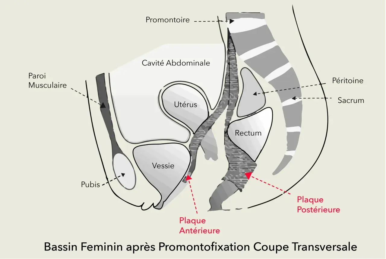 Coupe transversale du bassin féminin montrant la convalescence après promontofixation, avec utérus, vessie, rectum et plaques de fixation.