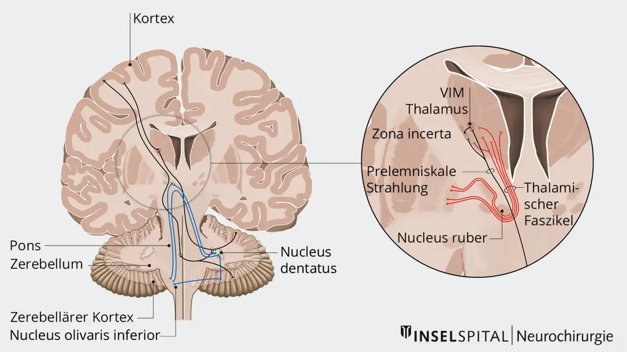 Hirnschnitt mit Darstellung von Nervenbahnen, die vom Kortex zum Thalamus und Kleinhirn verlaufen. Der primäre Fokus liegt auf dem Thalamus und seinen Verbindungen.
