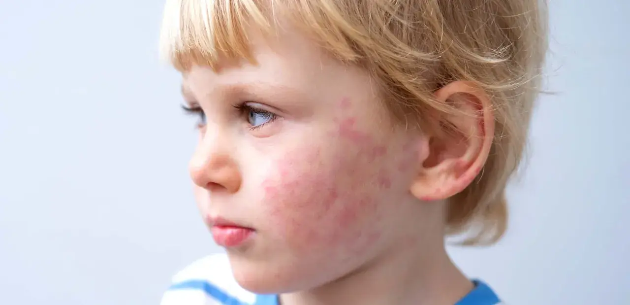 Primo piano del viso di un bambino con macchie rosse sulle guance, possibili macchie allergie alimentari bambini.