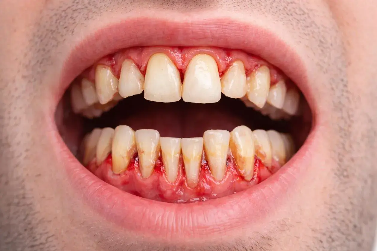 Encías inflamadas y enrojecidas alrededor de los dientes, indicativo de periodontitis leve.