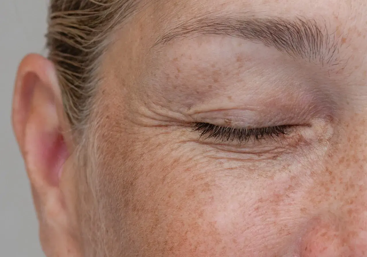 Primo piano del viso con occhio chiuso, rughe d'espressione e tante macchie di sole.