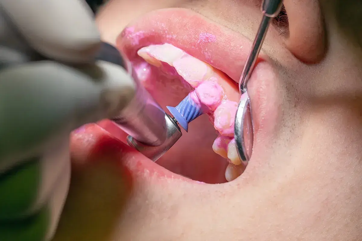 Dettaglio di un trattamento di igiene orale: il dentista usa uno strumento rotante per pulire i denti, coperti da una pasta rosa.