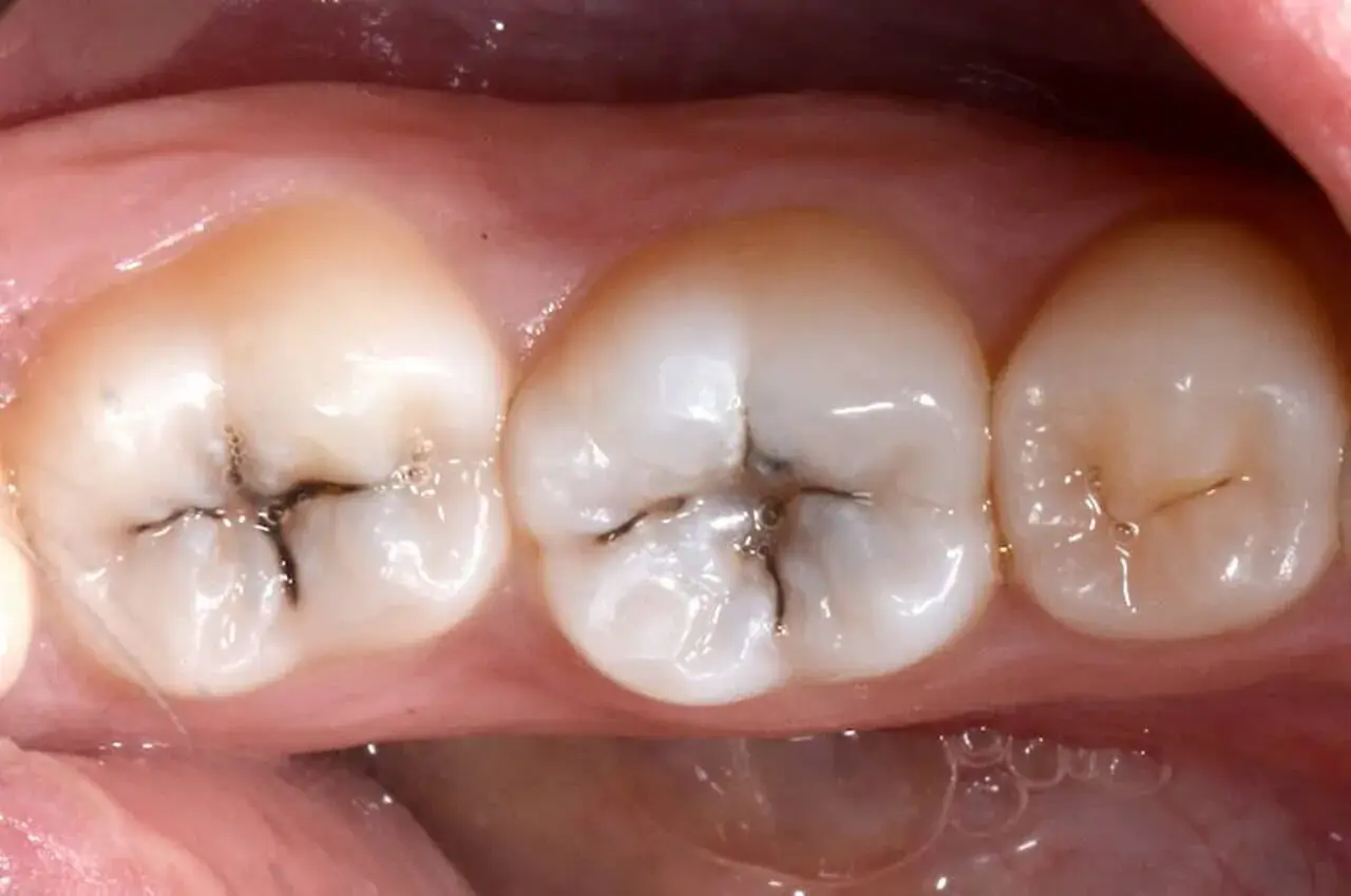 Denti con piccole carie scure nelle fessure.