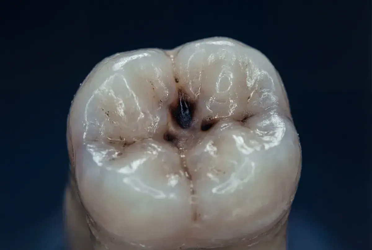 Dente con una cavità scura al centro, un chiaro segno di carie. I sintomi iniziali possono essere sottili, ma questa immagine mostra la progressione.