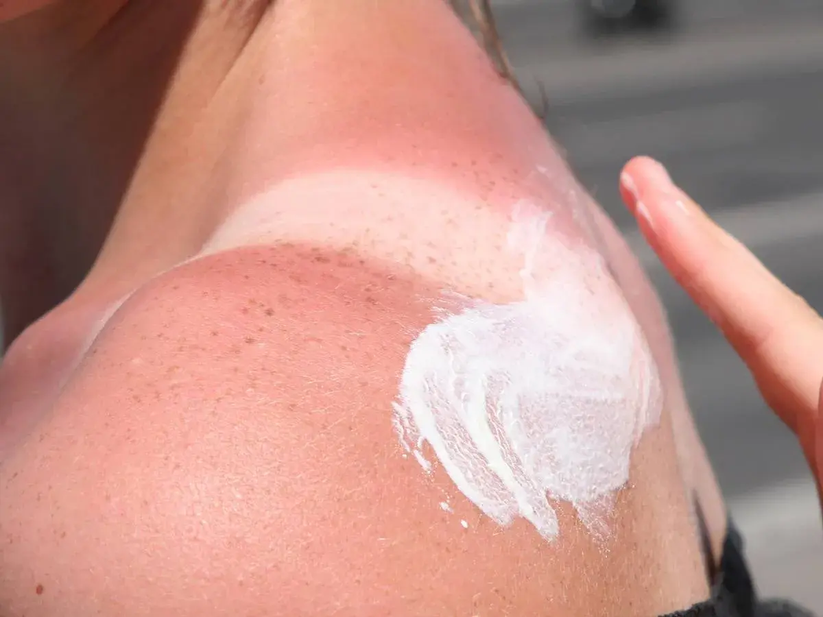 Schulter mit starkem Sonnenbrand, Rötungen und beginnenden Brandblasen. Eine Hand trägt Sonnencreme auf, um die Haut zu beruhigen.