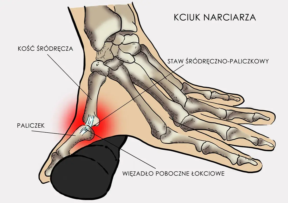 Anatomia kciuka narciarza: kość śródręcza, paliczek i staw śródręczno-paliczkowy. Czerwony obszar wskazuje ból.