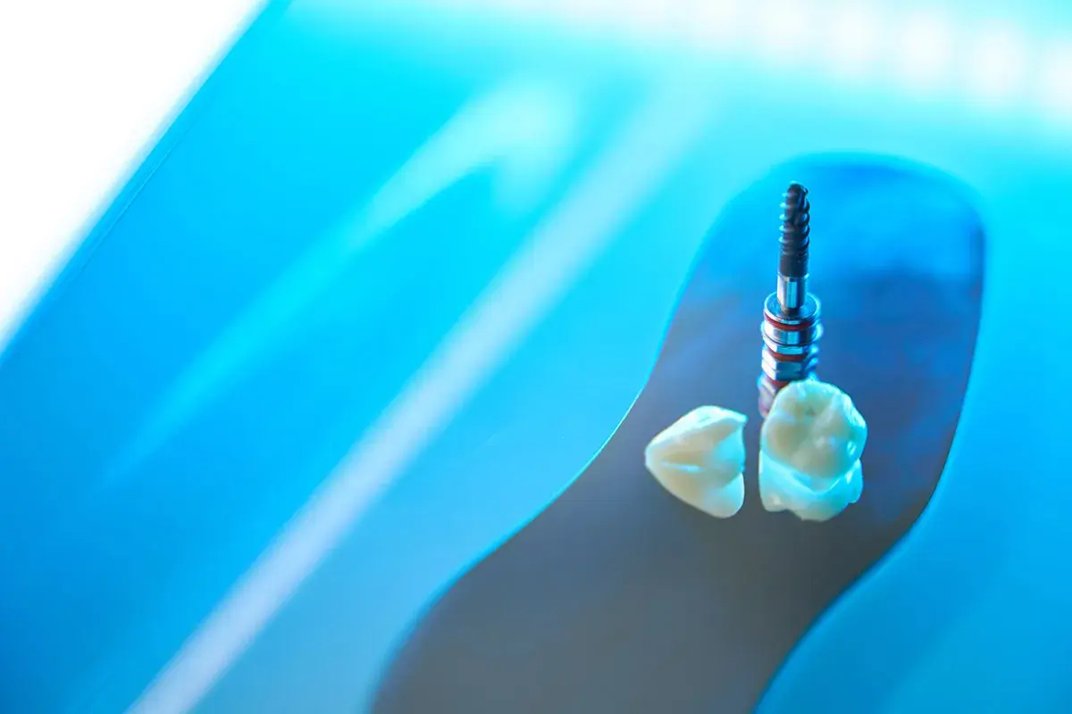 Impianti in zirconia e corone dentali, un futuro di sorrisi perfetti.