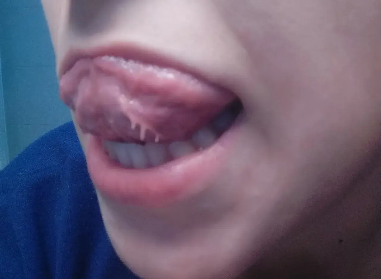 Lingua con escrescenze biancastre e filiformi che pendono.