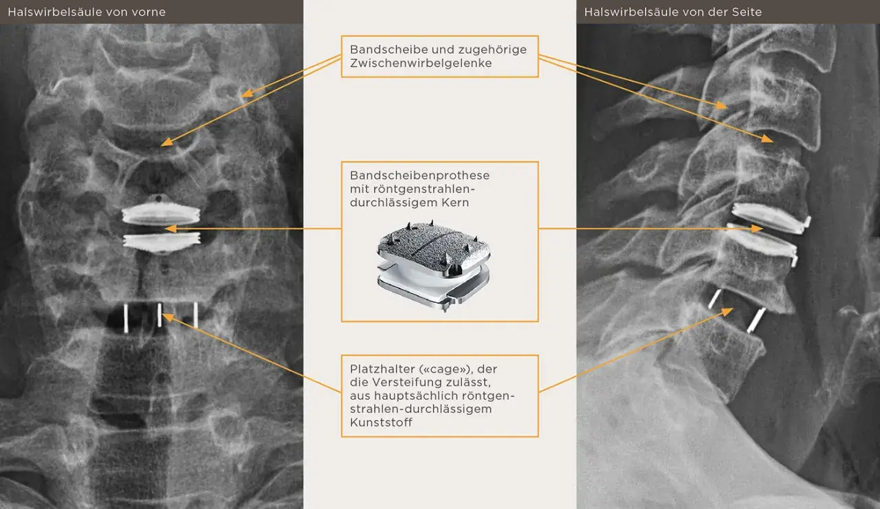 Röntgenbilder der Halswirbelsäule zeigen eine Bandscheibenprothese mit einem röntgendurchlässigen Kern und einem Platzhalter ("cage") für die hws versteifung.