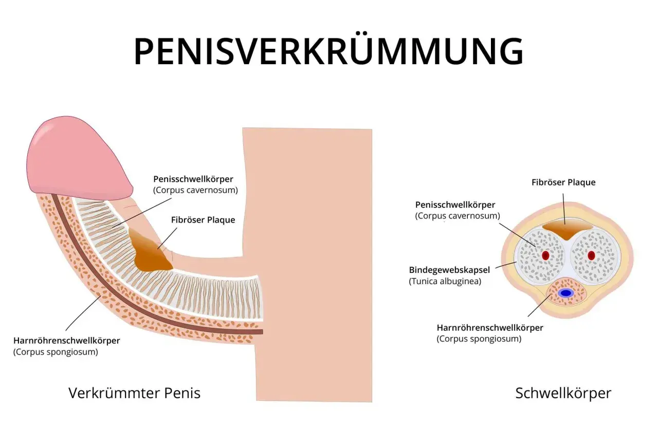 Illustration zeigt einen verkrümmten Penis mit fibrosen Plaques, die den Penisschwellkörper beeinträchtigen. Ein "buried penis" ist hier nicht dargestellt.