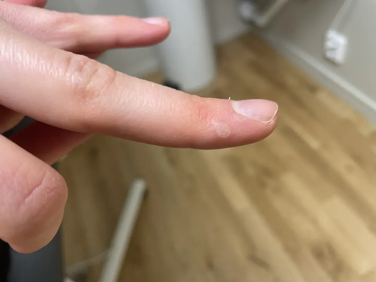 Närbild på en finger med en liten vårta på handflatan. Vårtan har en ringformad struktur.