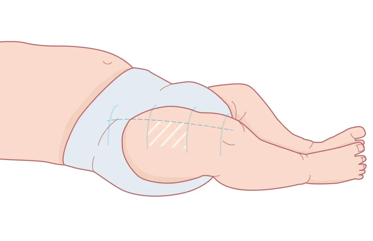 Illustration av ett barns lår med en ljusblå blöja. Markeringar på låret indikerar var 3 månaders vaccin ges.