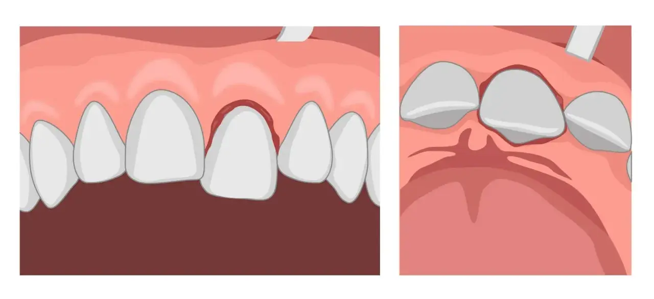 Illustrazione di gengive infiammate e denti che si allentano, suggerendo la possibilità di denti che cadono senza dolore.