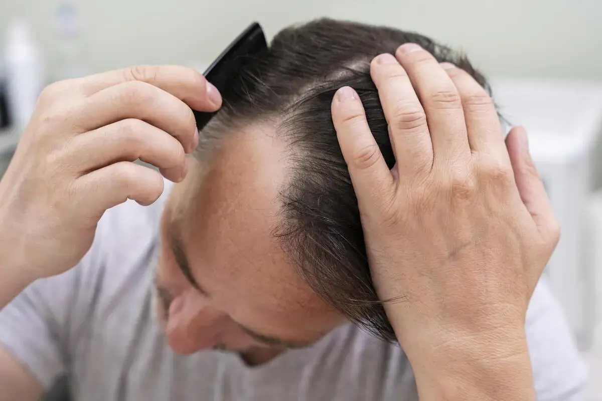 Hombre revisando su cabeza, preocupado por la caída de cabello.