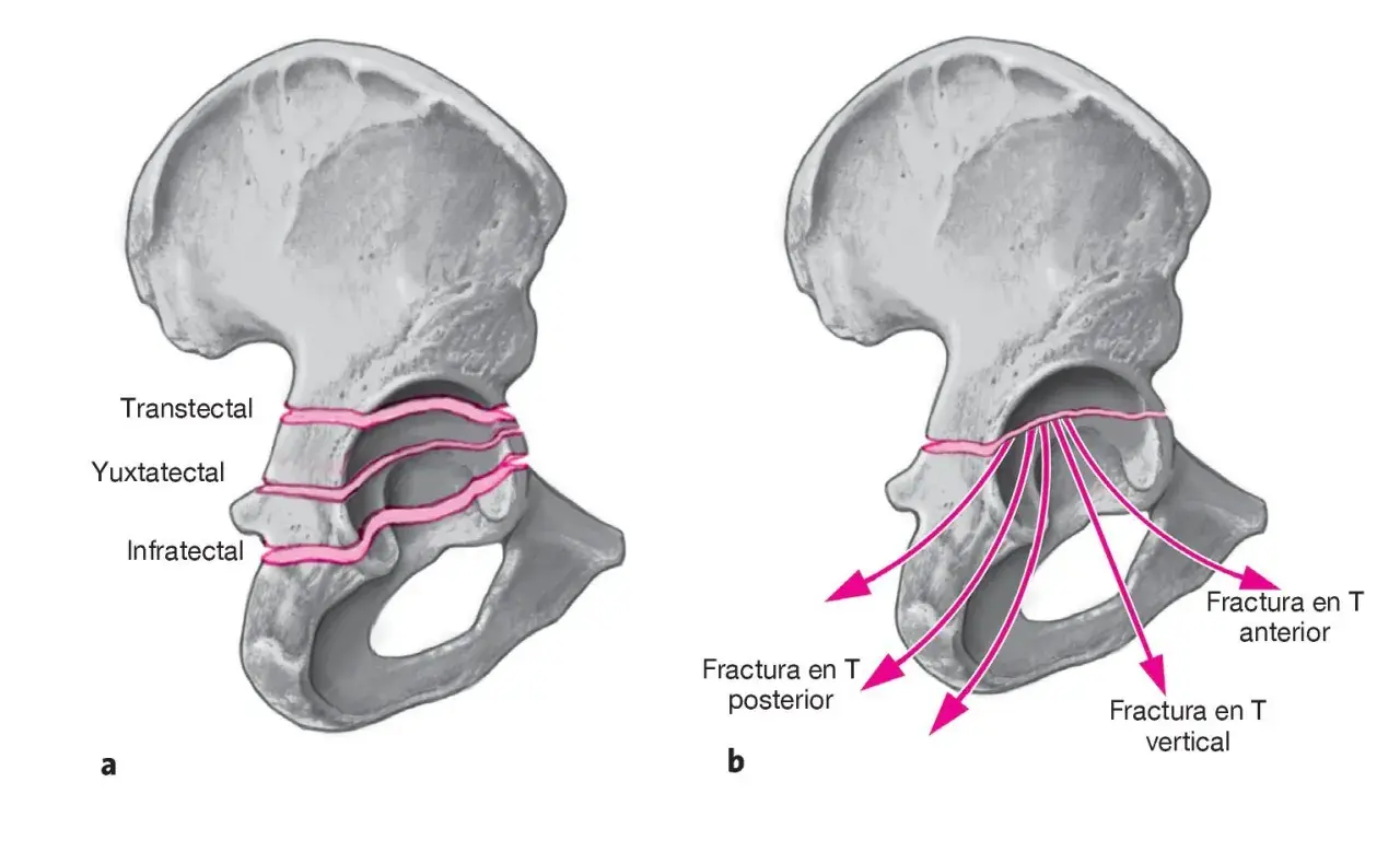 Ilustración de pelvis con fractura en rodete. A muestra tipos transtectal, yuxtatectal e infratectal. B muestra fractura en T anterior, posterior y vertical.